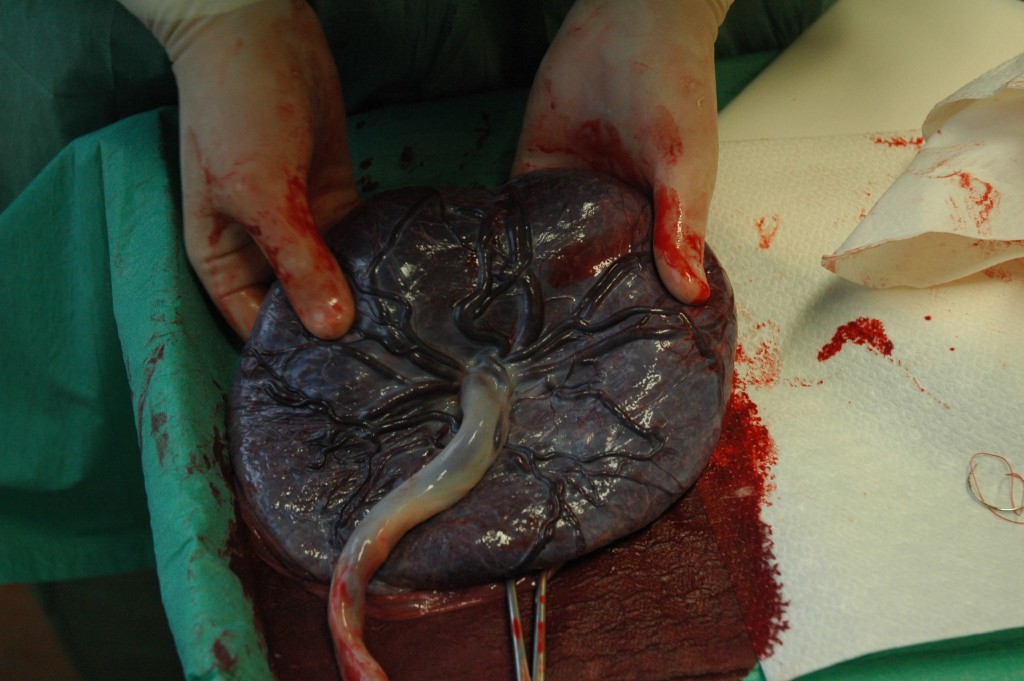 Placenta_held