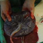 Placenta_held