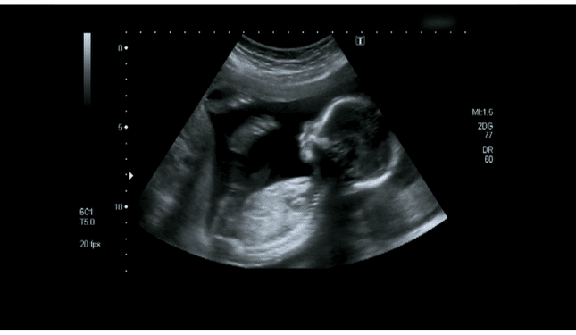 Ultrasound in Pregnancy – Safe and Sound? – Episode 6